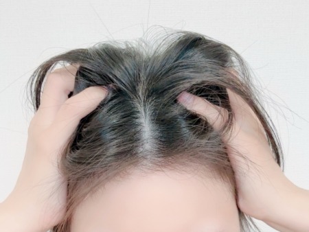 30代女性の薄毛は治る？原因と対策方法
