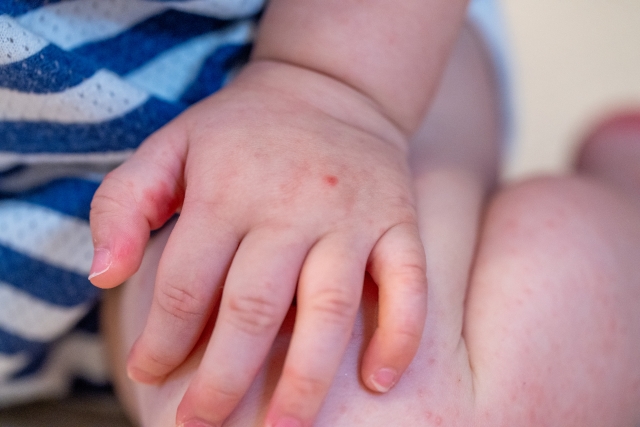 子供にも起こる皮膚描記症の対策