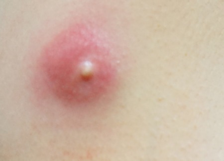 炎症性粉瘤とは？症状・原因について徹底解説