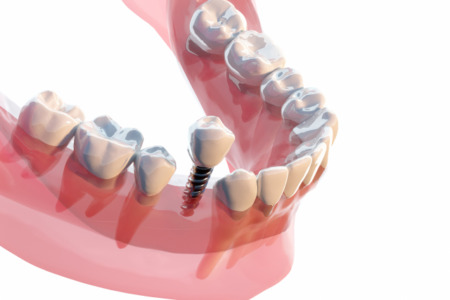 インプラントのメンテナンス方法とポイント｜長持ちさせるために必要なケア