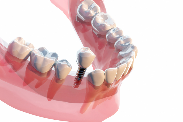 インプラントのメンテナンス方法とポイント|長持ちさせるために必要なケア
