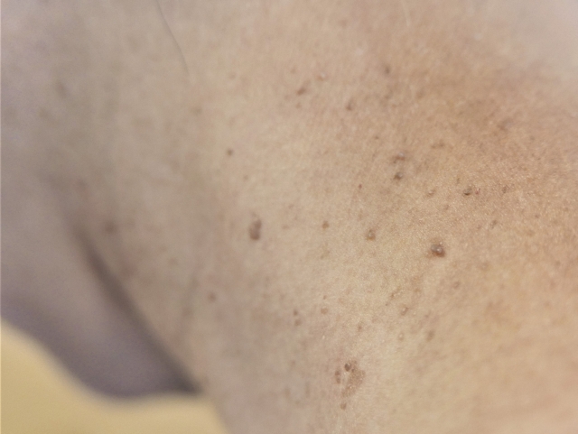 粉瘤ができやすい部位