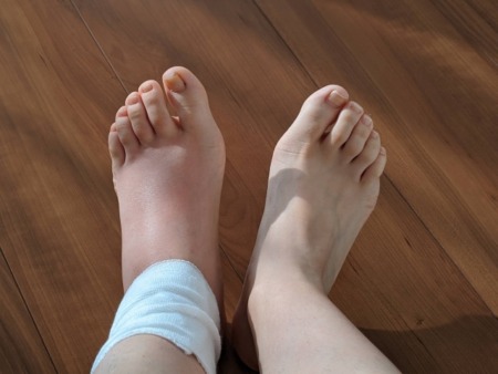 皮膚浮腫の症状と原因｜効果的な対処法