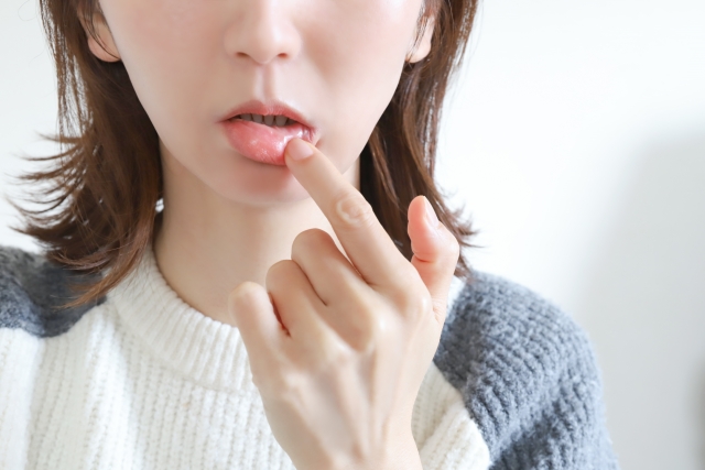 口内炎と口唇ヘルペスの違いを徹底解説|症状や原因、治療法について